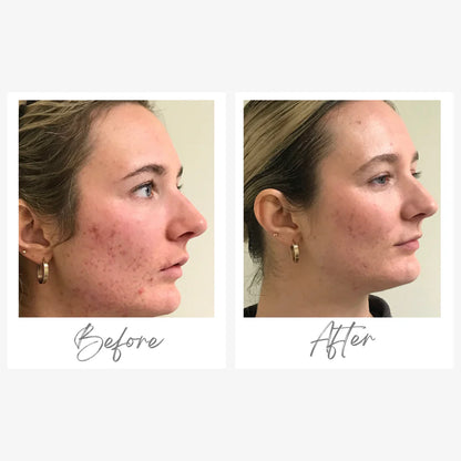 Skin Formulas Breakout Routine Bundle